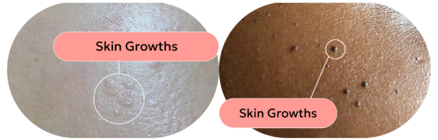 skin with skin growths